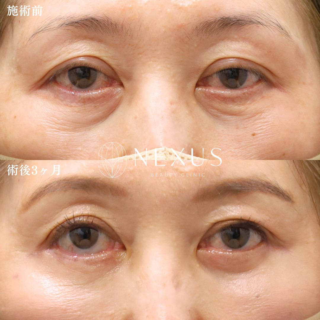 切開ハムラ＋脂肪注入 症例写真
