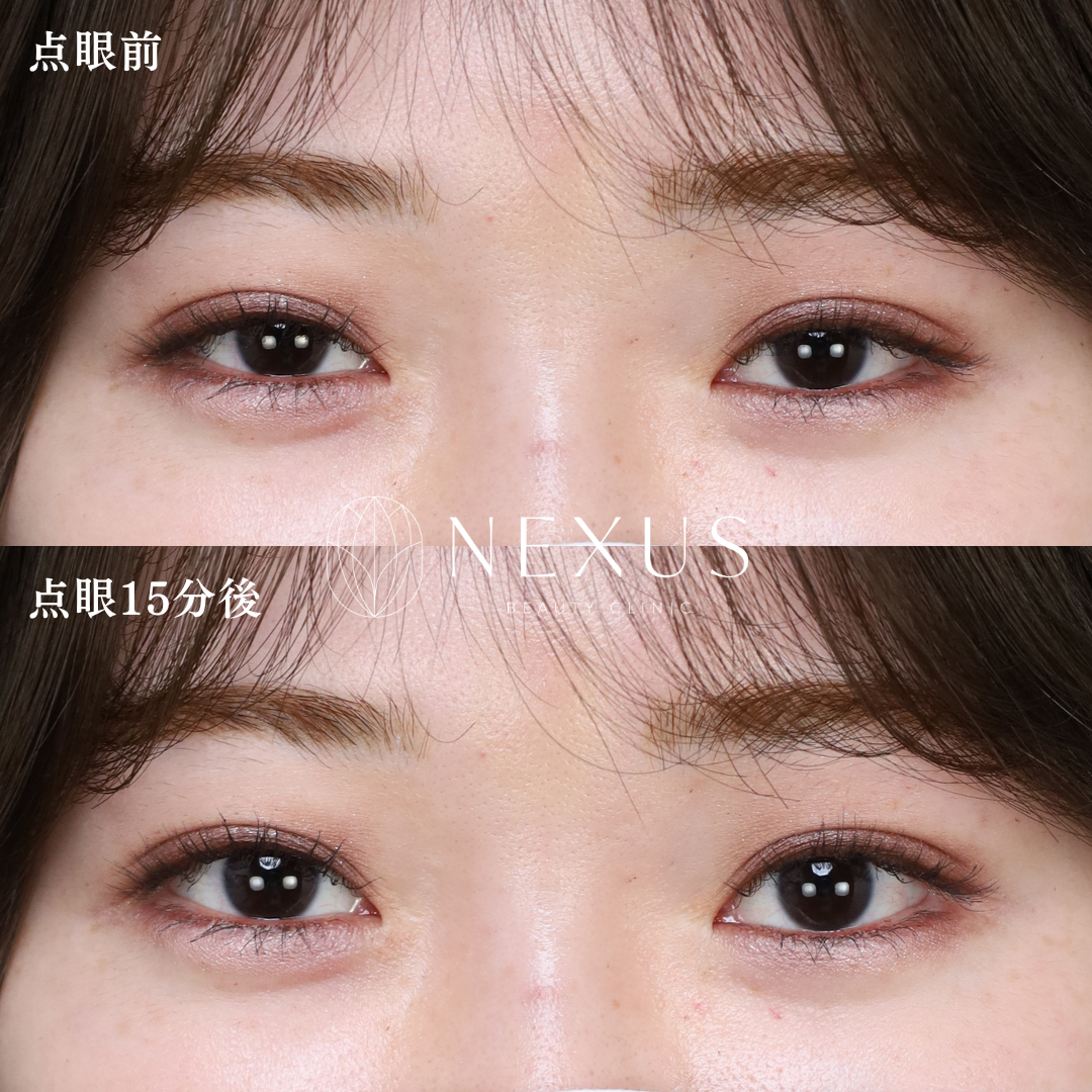 アップニーク点眼薬 症例写真