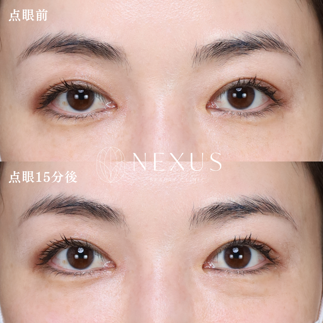 アップニーク点眼薬 症例写真