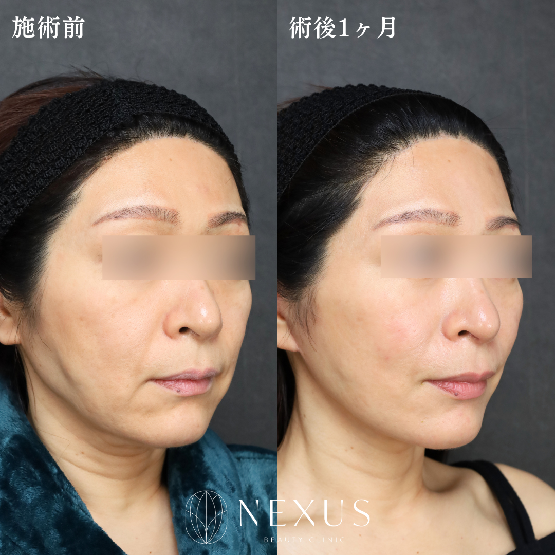 ミニフェイスリフト 症例写真